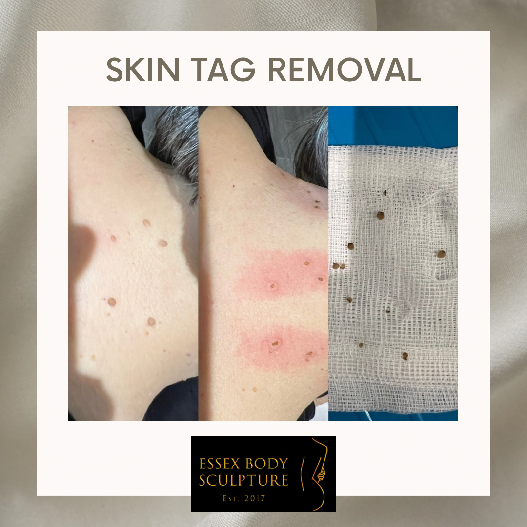 Skin Tag Removal