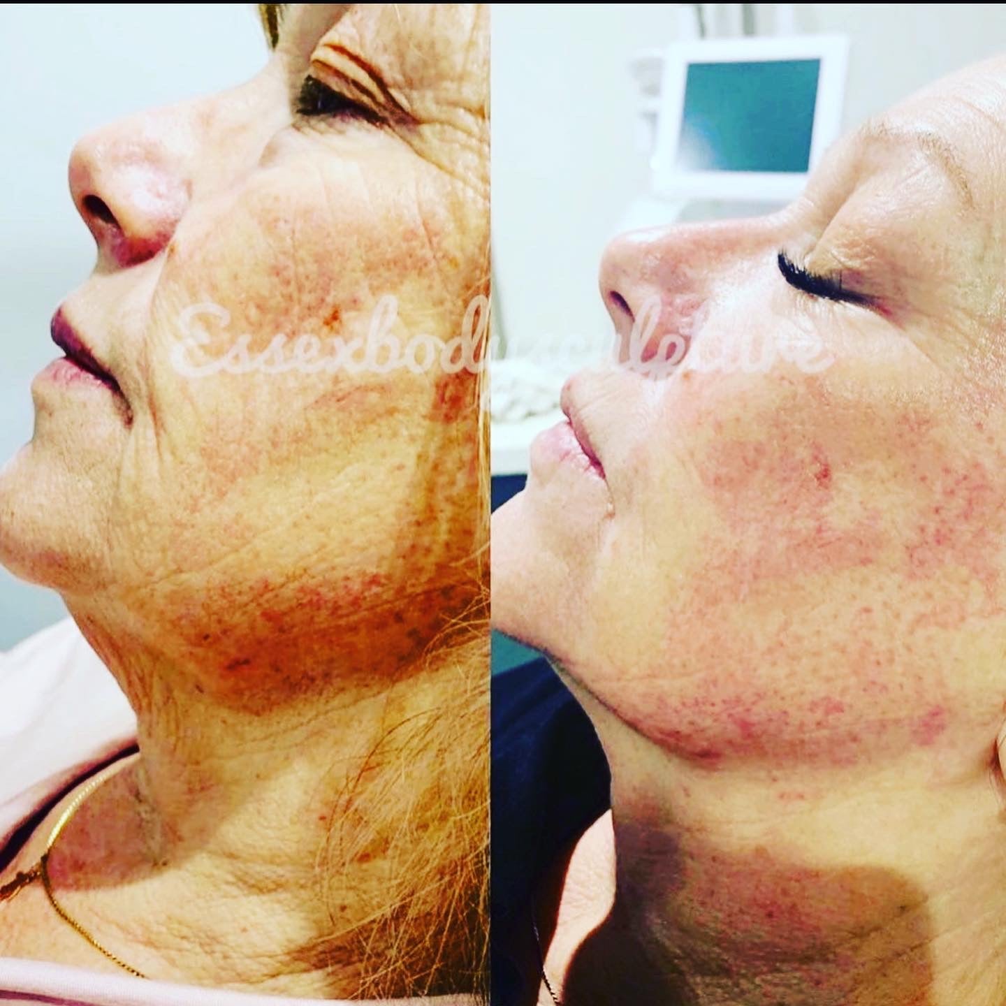 Radio Frequency Non Surgical Face Lift