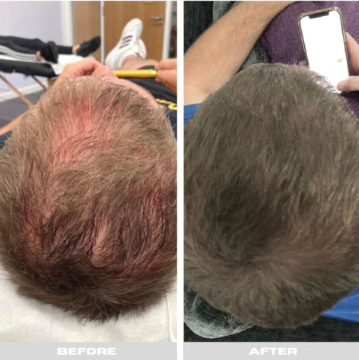 PRP Hair Restoration Single Session