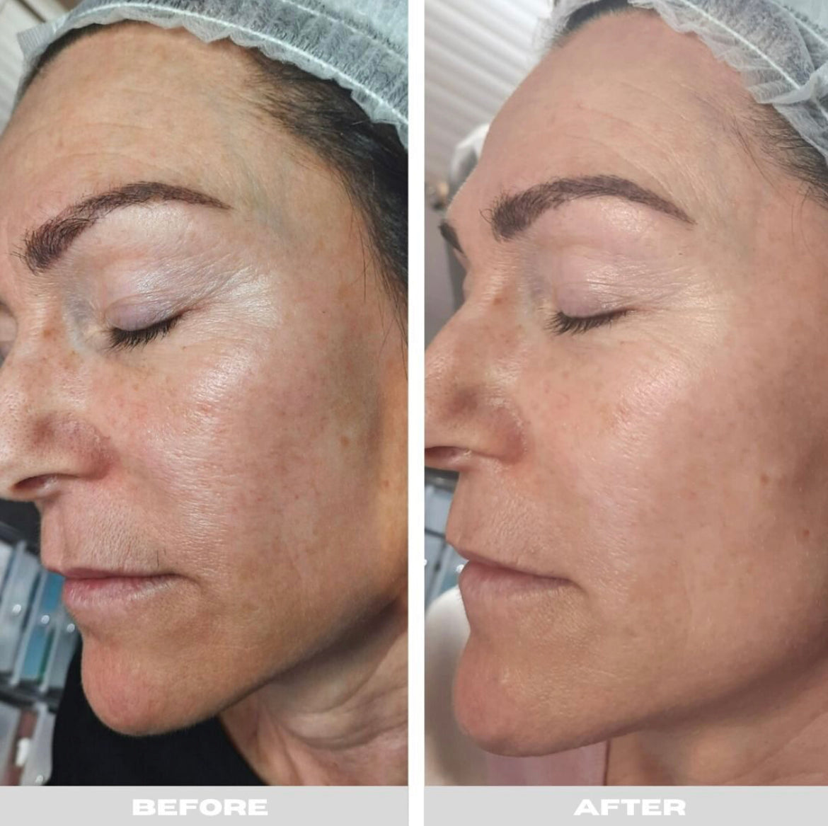 PRP Full face skin rejuvenation course of 3 sessions