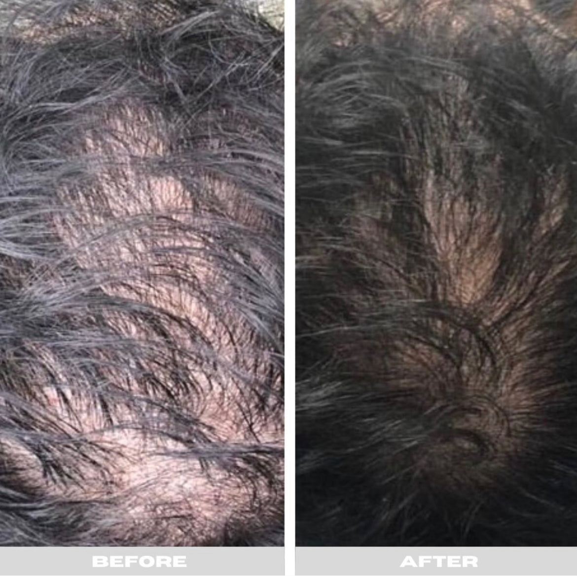 PRP Hair Restoration Course of 6 Sessions