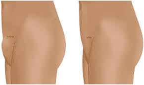 Mons Pubis Fat Reduction
