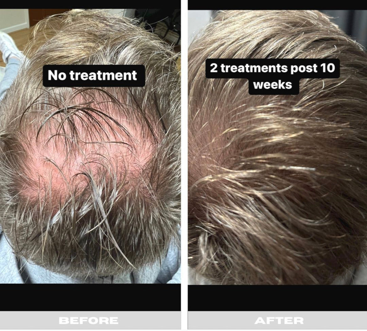 PRP Hair Restoration Single Session